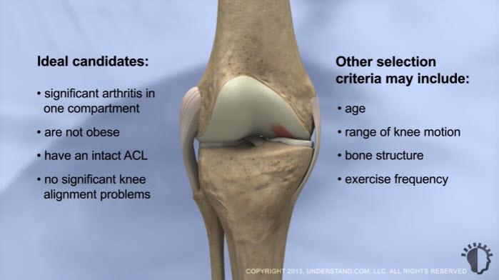 Patient Criteria Partial knee replacements are reported to feel more natural than total knee replacements, but ideal candidates must fit selection criteria.