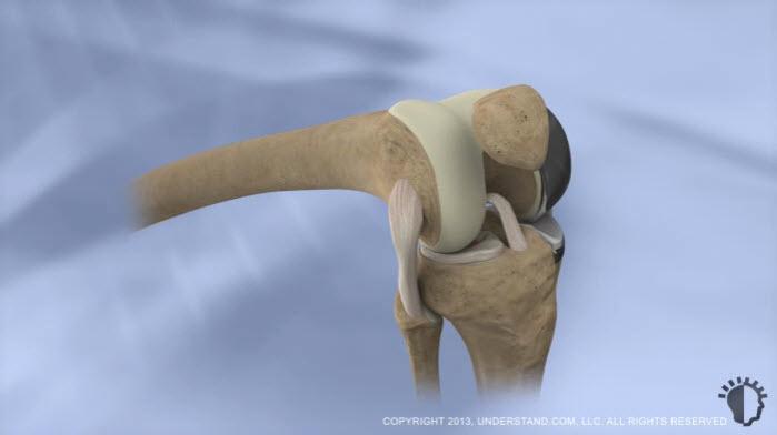 Muscle and fatty tissue are carefully moved aside, and the patella is shifted to one side to provide access to the femur and tibia in the affected compartment.