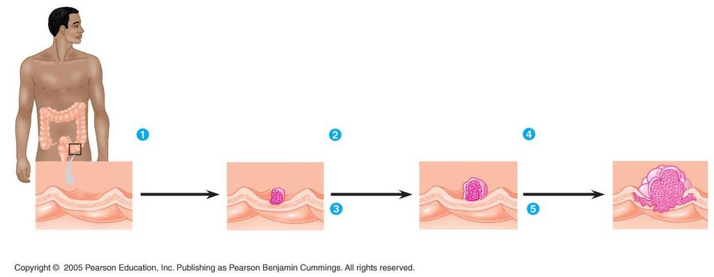 LE 19-13 Colon Colon wall Loss of tumorsuppressor gene APC (or other) Activation of ras oncogene Loss of tumorsuppressor gene p53 Normal colon