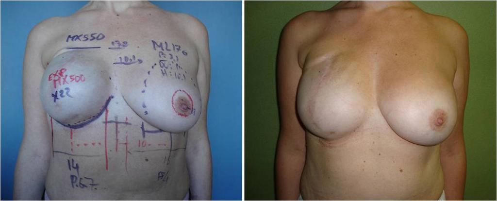 Eur J Plast Surg (2017) 40:203 212 209 underwent delayed lipofilling. The surgeons evaluation of esthetic outcome was predominantly good for breast shape (67.1%) and symmetry (60.3%), and 69.