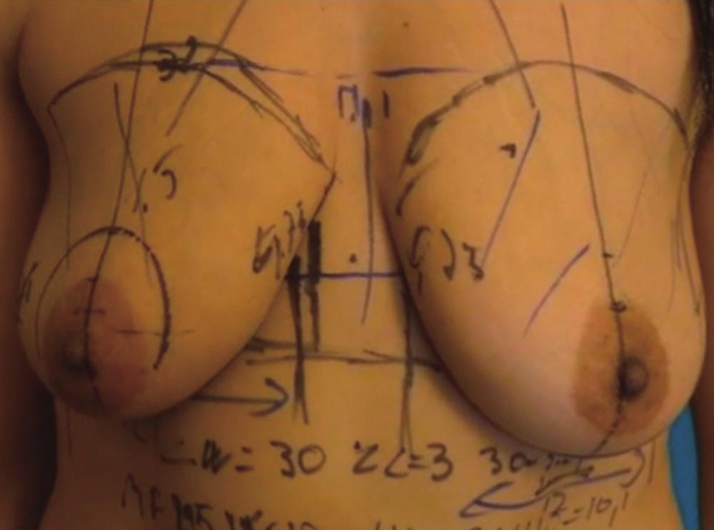 Preoperative planning of breast augmentation: key measurements. en-imf, existing nipple inframammary fold.