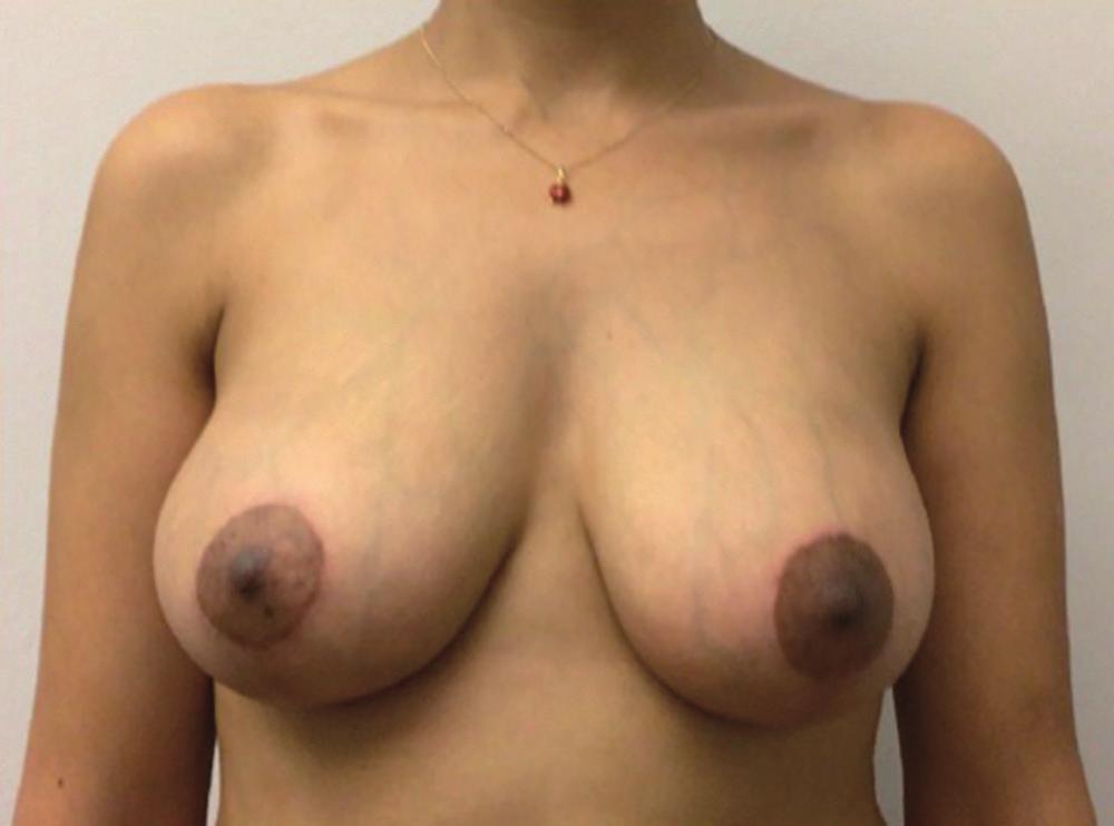 1). The dimensions determine the volume, not vice-versa. The surgeon must assess the breast volume, which is classified as very small, small, or medium.