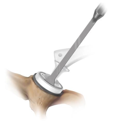 Step 6 Insert Femoral Head into Constrained Liner When relocating the reconstructed joint, significant force is required to ensure that the head is seated in the constrained acetabular component.