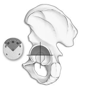 PROCOTYL E acetabular cup system SURGICAL TECHNIQUE Proper surgical procedures and techniques are the responsibility of the medical professional.