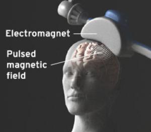 Magnetic Transcranial Magnetic Stimulation TMS MST