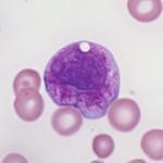 Acute Promyelocytic Leukemia PML-RARA t(15:17) N= PML (15q22) NPM (5q35) NuMA (11q13) PLZF