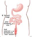 rectum Usually done in stages 1.