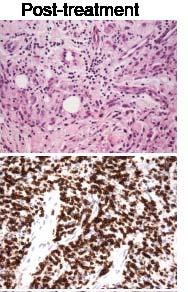 8 weeks of topical IMQ brisk T cells infiltrate histological