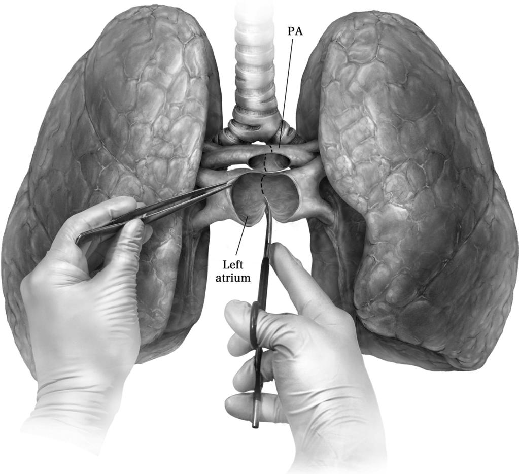 Bilateral lung transplantation 183 tification of the artery in the interlobar fissure and the arterial supply of the resected lobe is ligated.