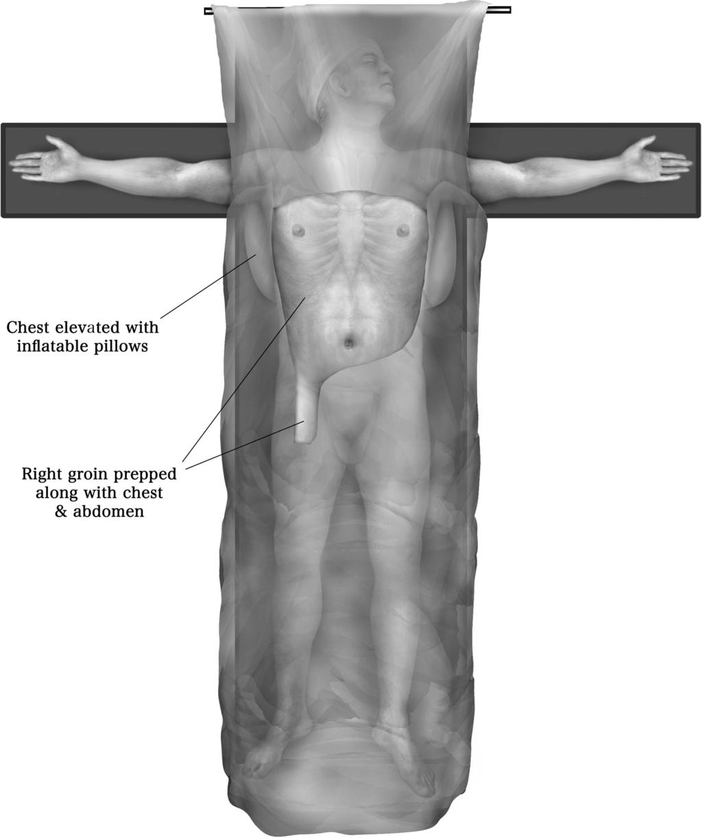 184 C. Aigner and W. Klepetko Figure 2 Positioning of the patient for bilateral lung transplantation is supine with abducted arms and the chest elevated by inflatable cushions.