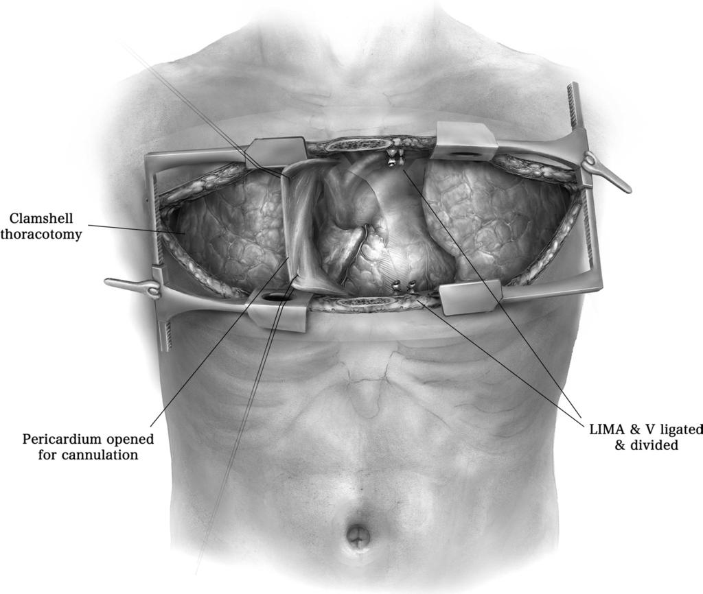 186 C. Aigner and W. Klepetko Figure 4 The so-called clamshell incision is a bilateral thoracotomy in the fourth intercostal space connected by a transverse sternotomy.