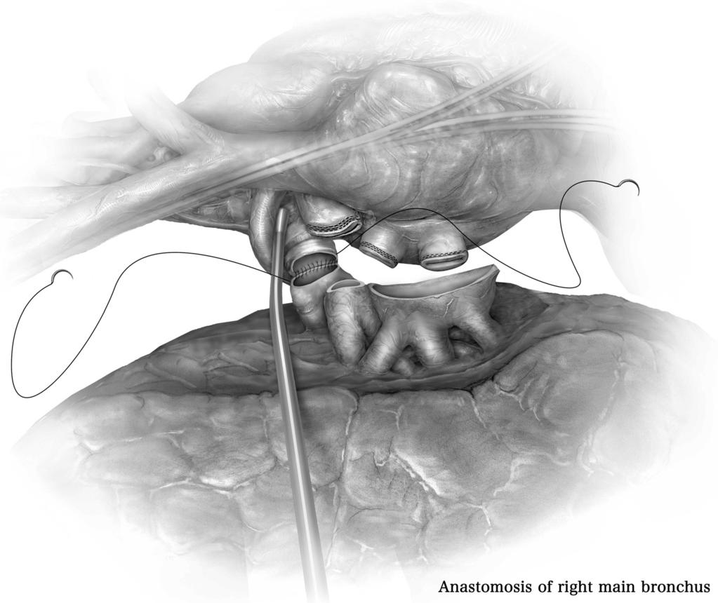 188 C. Aigner and W. Klepetko Figure 6 The bronchial anastomosis, which is the first step in implanting the donor lung.