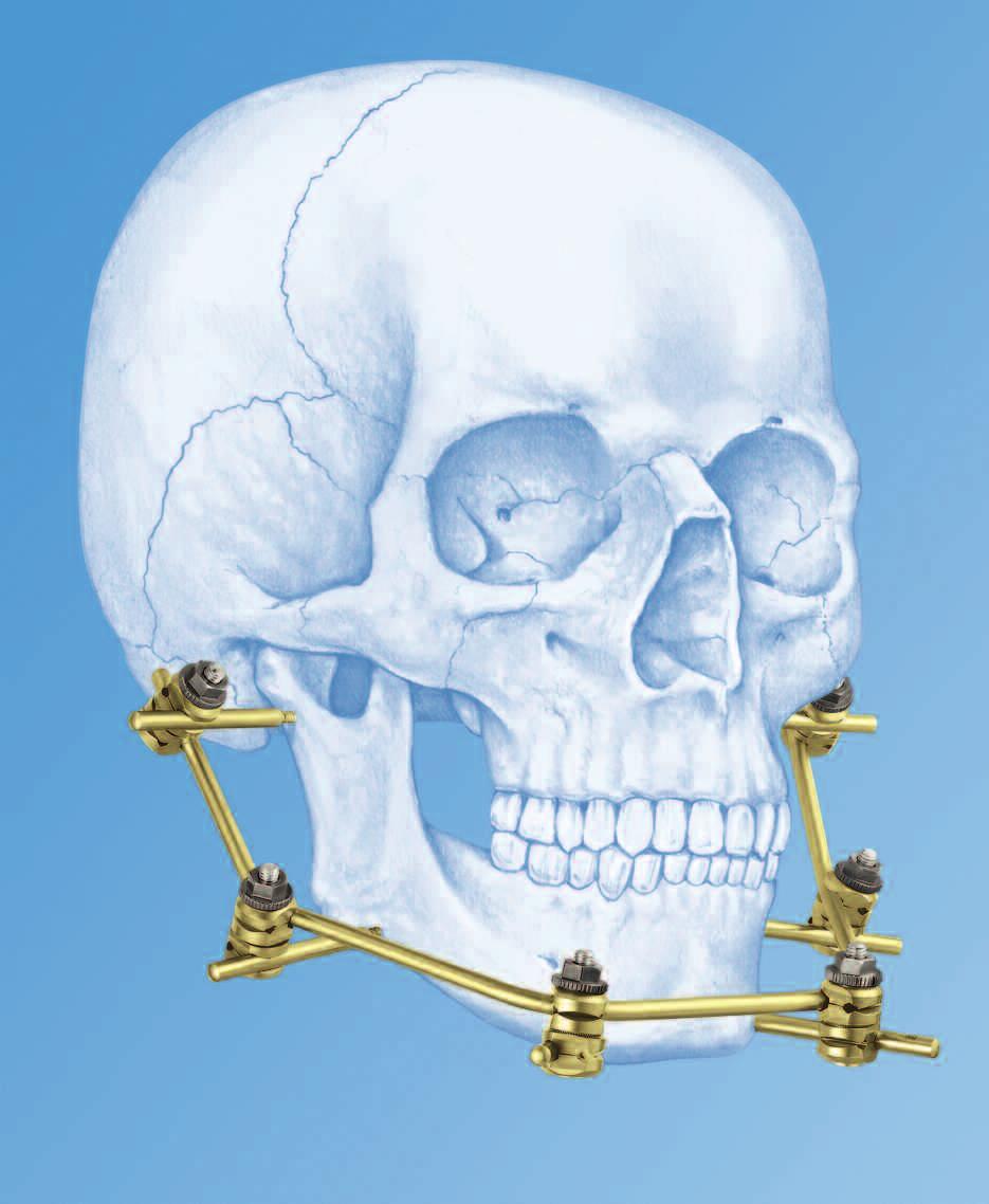Mandible External Fixator II. Provides treatment for fractures of the maxillofacial area.