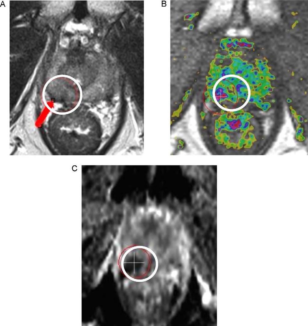 EUROPEAN UROLOGY 59 (2011) 962 977 971 Table 4 Planning for external-beam radiation therapy Actual diagnostic tools What MRI could offer clinicians Potential limits of MRI Prostate-specific antigen