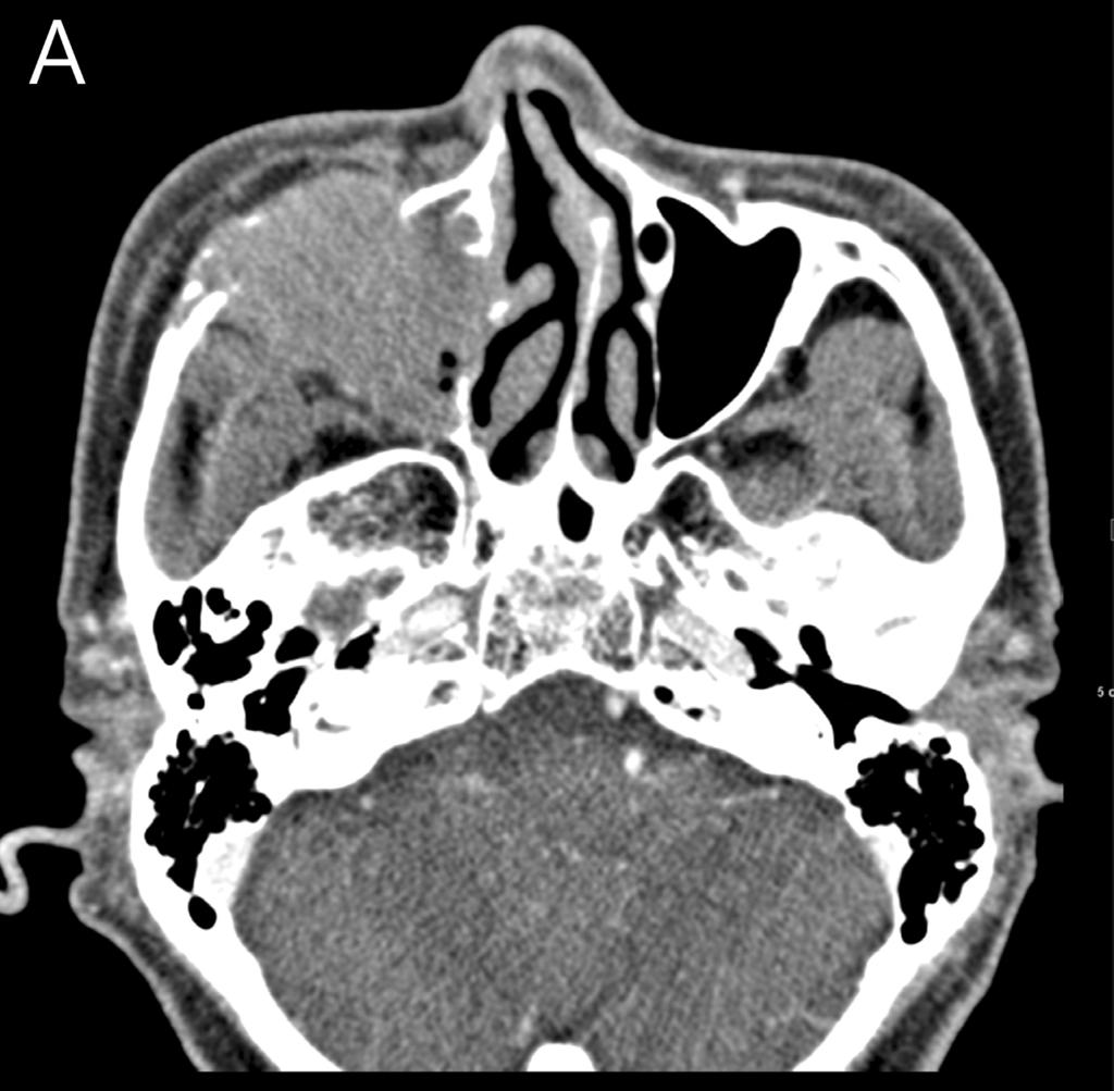 the upper right first maxillary sinus. The tumor intruded into not only molar(fig. 4b).