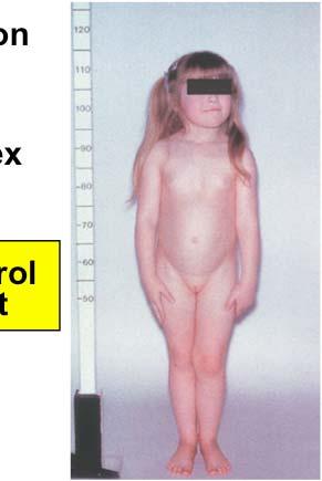 old Precocious puberty central ideopathic (girl) &