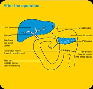 The surgeon reconnects the remaining part of the pancreas, bile duct and stomach (or duodenum) to different sections of the small bowel to keep the digestive tract working.