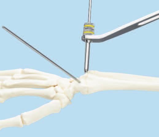 Avoid penetrating the far cortex with the pin. When using Schanz screws, insert by hand to avoid damage to soft tissues.