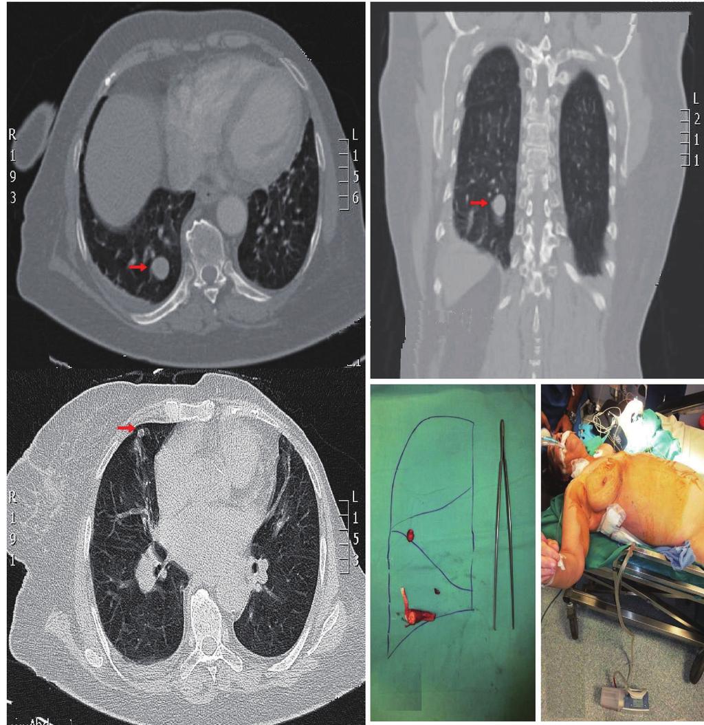 Tsakiridis et al Surgery for pulmonary metastases of RCC 70 A C B D E Figure 1 Preoperative imaging, immediate postoperative specimen and patient photographs (Case 1) A and B Preoperative contrast CT