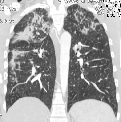 Figure 3: Coronal and Axial HRCT and CT showing
