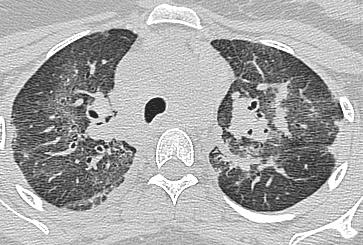Figure 4: Axial HRCT and CT showing large nodules