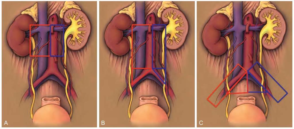 Template of extended lymphadenectomy in UTUC Renal