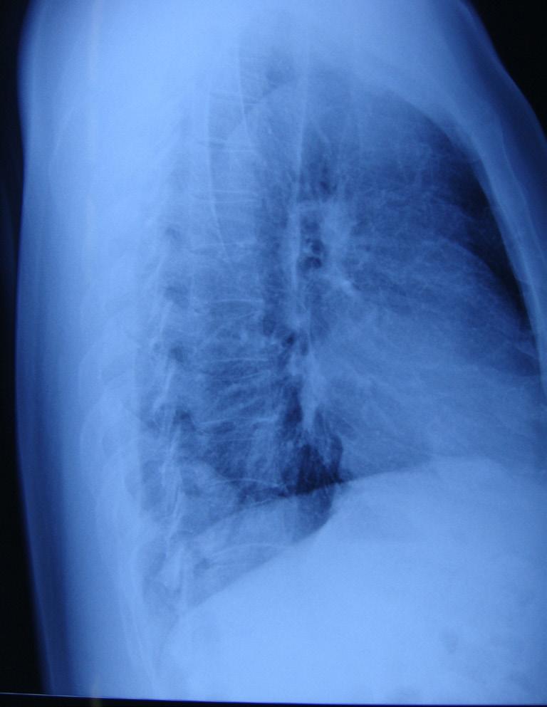 hook till the inferior pulmonary vein level (Figures 6,7).