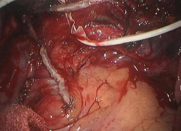(VIII) Remove the interlobar lymph nodes (Figure 13).
