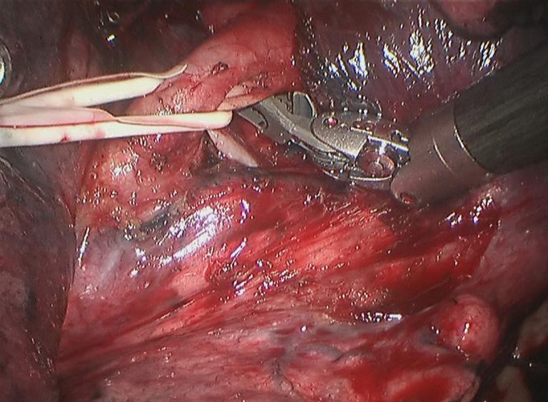 Figure 15 Pull the artery in the basal segment of lower lobe
