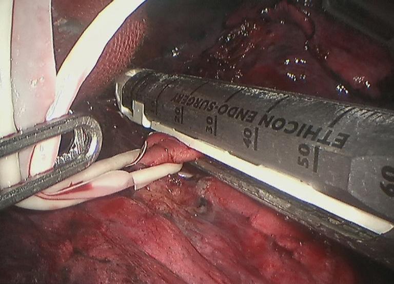 Basal segmental artery Figure 13 Remove the interlobar lymph