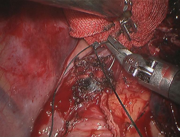 via the incision. Figure 23 Completely remove the subcarinal lymph nodes.