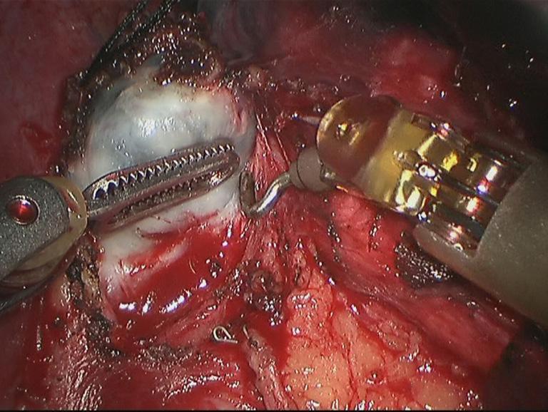 An extraction bag was inserted to harvest the completely resected right inferior
