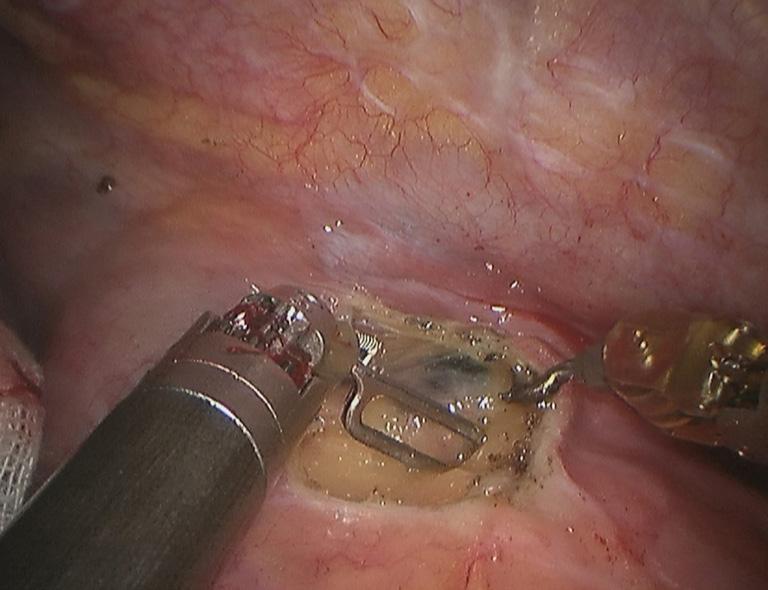 Page 6 of 6 Xu et al. Robotic-assisted right inferior lobectomy Figure 24 Remove the lymph nodes near the trachea. Figure 26 Remove the lymph nodes in front of the trachea.