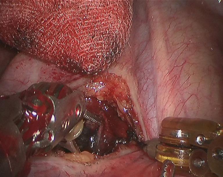 The robotic arms were withdrawn after the bleeding was stopped. Close the chest after a closed chest drainage tube was placed at the camera port.