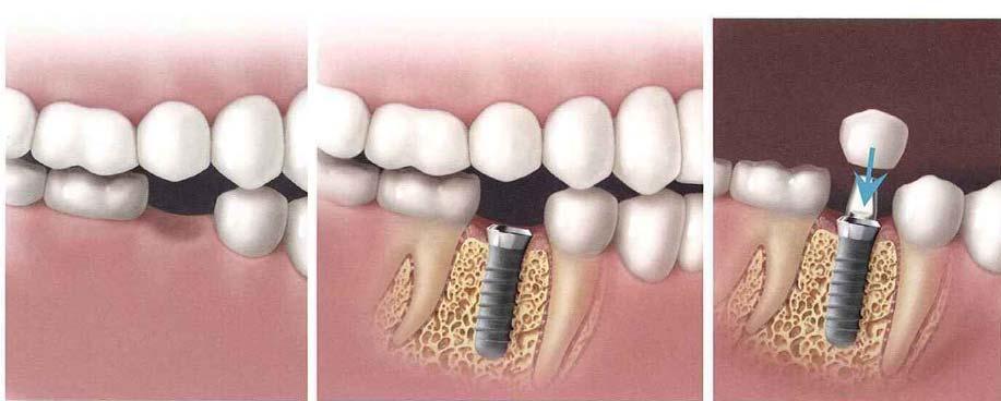 Bridges replace missing teeth Implants An artificial root used to