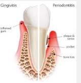 Periodontal (gum) Treatment Oral Hygiene Instruction Scaling and Root Planing (Deep cleaning) Surgical Therapy