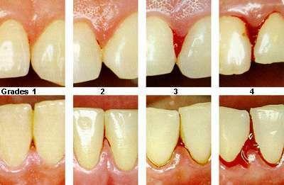 compared to a traditional regimen of manual tooth brushing and flossing 105 subjects