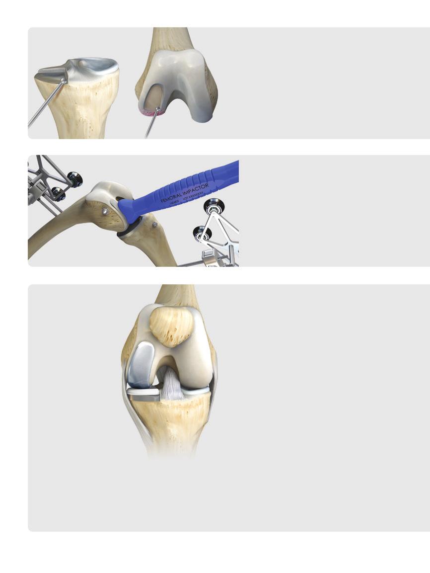 6. Resect the femoral and tibial surfaces, then create peg holes and keels. 7. Remove any meniscus and other soft tissues. Clean up the joint and install trial components.
