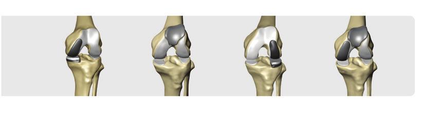 MAKOplasty PKA Comprehensive Solutions Medial Patellofemoral Lateral Bicompartmental Indications RIO for Partial Knee Replacement (K112507 March 2012): The RESTORIS Partial Knee Application, for use