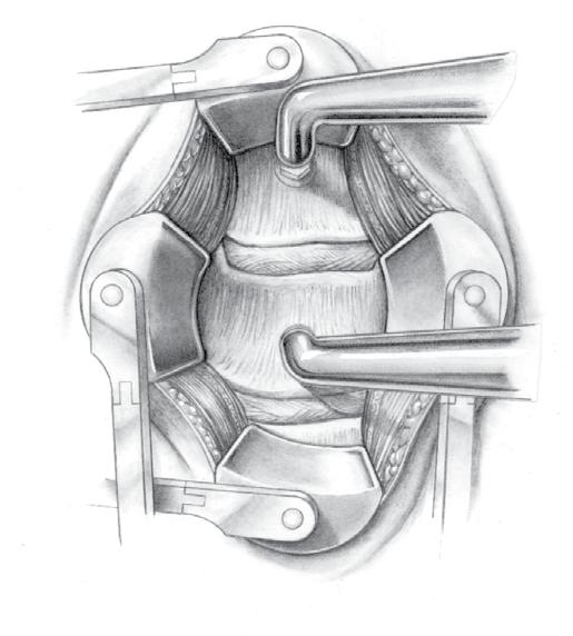 Surgical Technique Step 3: removal of the disc and preparation of the endplates Cautery is used in the midline over the cervical spine, followed by a peanut sponge to reflect the fascia and longus