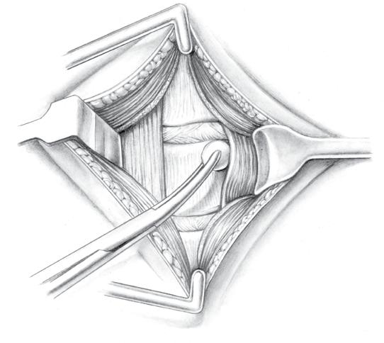 The smooth blades are placed superior-inferior. A 22-gauge spinal needle is placed in the appropriate disc and a lateral X-ray taken to verify anatomic level.