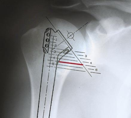 This is done by evaluating x-rays of the fracture and the opposite normal shoulder as well as intra-operative identification of proximal bone loss.