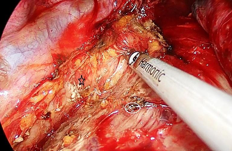 Journal of Visualized Surgery, 2017 Page 3 of 7 Figure 4 Azygos vein is divided with an endoscopic vascular stapler fully angled to the right side.