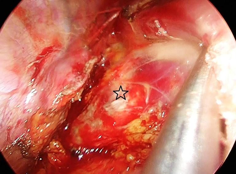 Figure 5 Branches from the aorta (black star) are divided with an energy device. Esophagus (white circle) is retracted anteriorly to open up the posterior mediastinal space anterior to the aorta.