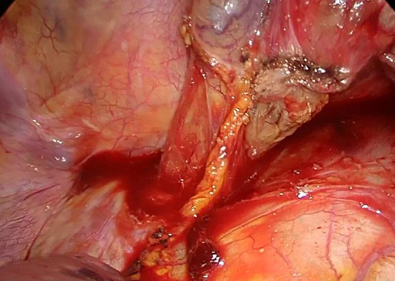 Page 4 of 7 Journal of Visualized Surgery, 2017 Video 3. Technique of intrathoracic linear stapled side to side esophagogastrostomy Hasan F.