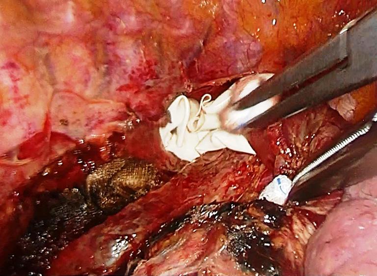 divided. The esophagus is lifted laterally and posteriorly at this stage. Figure 10 Technique of intrathoracic linear stapled side to side esophagogastrostomy (7). Available online: http://www.asvide.