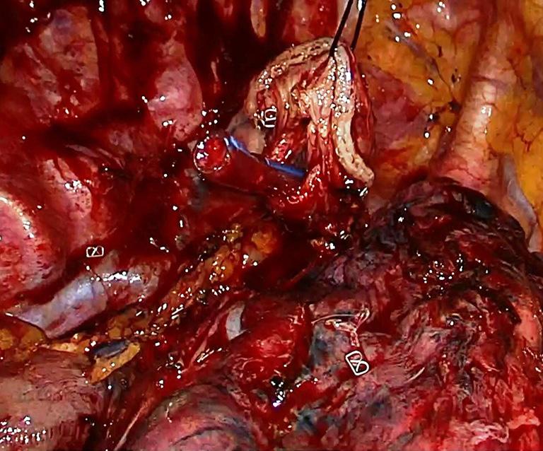 Journal of Visualized Surgery, 2017 Page 5 of 7 Figure 11 A nasogastric catheter is pushed out of the small esophagotomy.