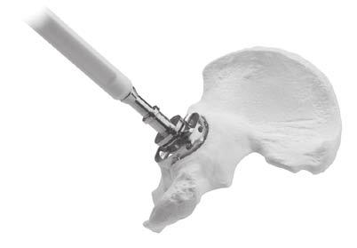 Place Provisional Shell into the prepared acetabulum using the positioner to check the sizing. Do not impact the provisional.