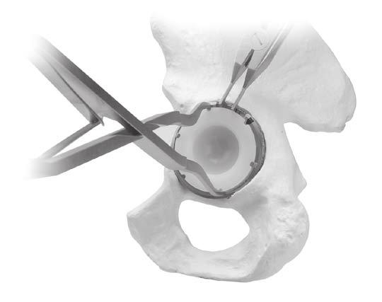 6 Trilogy Acetabular System Liner Insertion Push the liner into the shell.