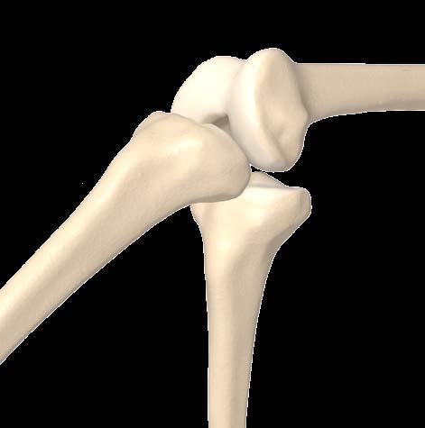Once range of motion is confirmed, a tibial screw should be inserted and the ligament cut flush to the bone completing the procedure.